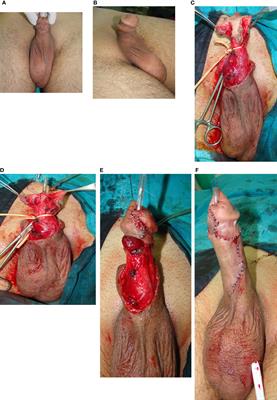 Adult non-urethral complications after hypospadias repair in childhood: presentation, treatment and outcomes